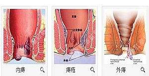 泉州治痔疮选什么办法好得快